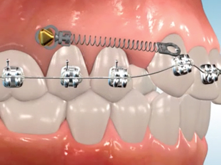 Orthodontic elastics springs coils and hooks